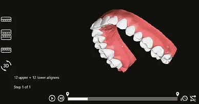 Stern Aligners, 3D Planning (Digital Impressions)